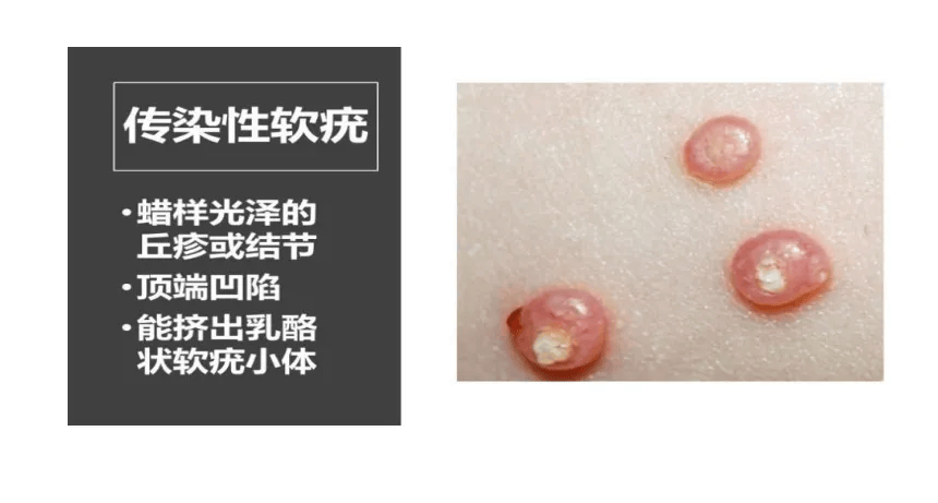 女孩游泳20多天全身長20多個疣！醫生提醒：泳池是傳播高危區，千萬別用手擠