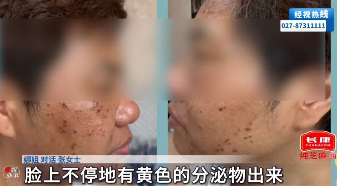 女子去美容店體驗276元淡斑套餐，被塗抹不明藥水，店員：半小時內不交1萬元就會毀容