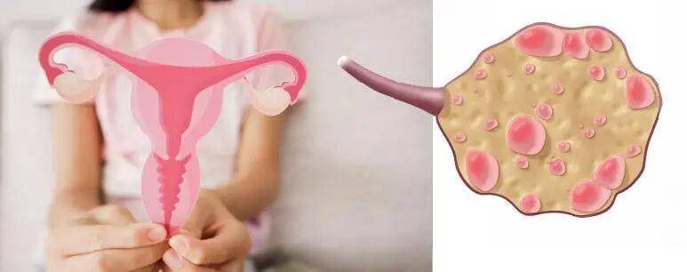 三個月不來月經、體毛濃密，這一影響上億女性的病更名了
